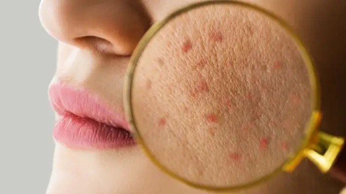 Dermatology